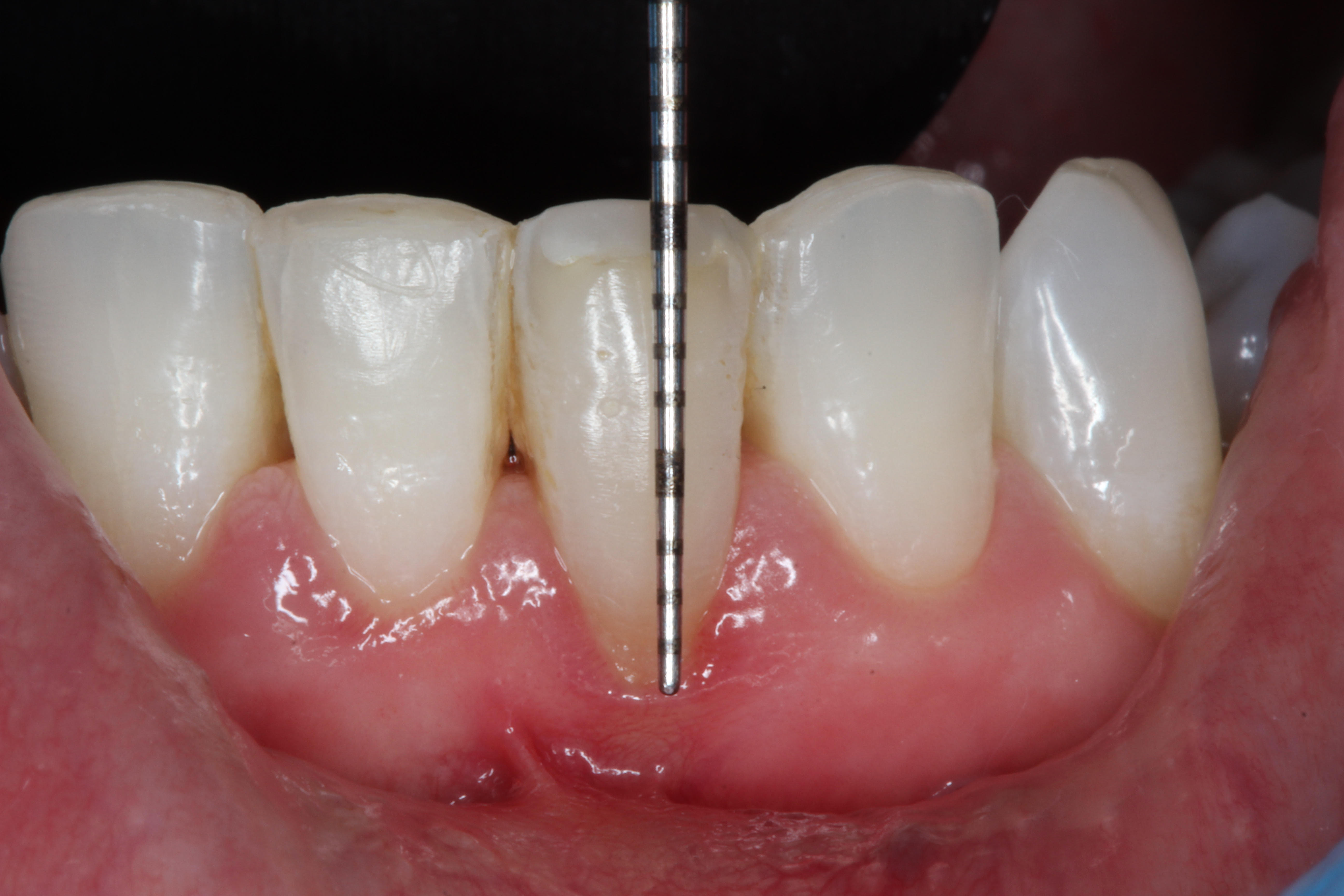 Tratamientos de periodoncia