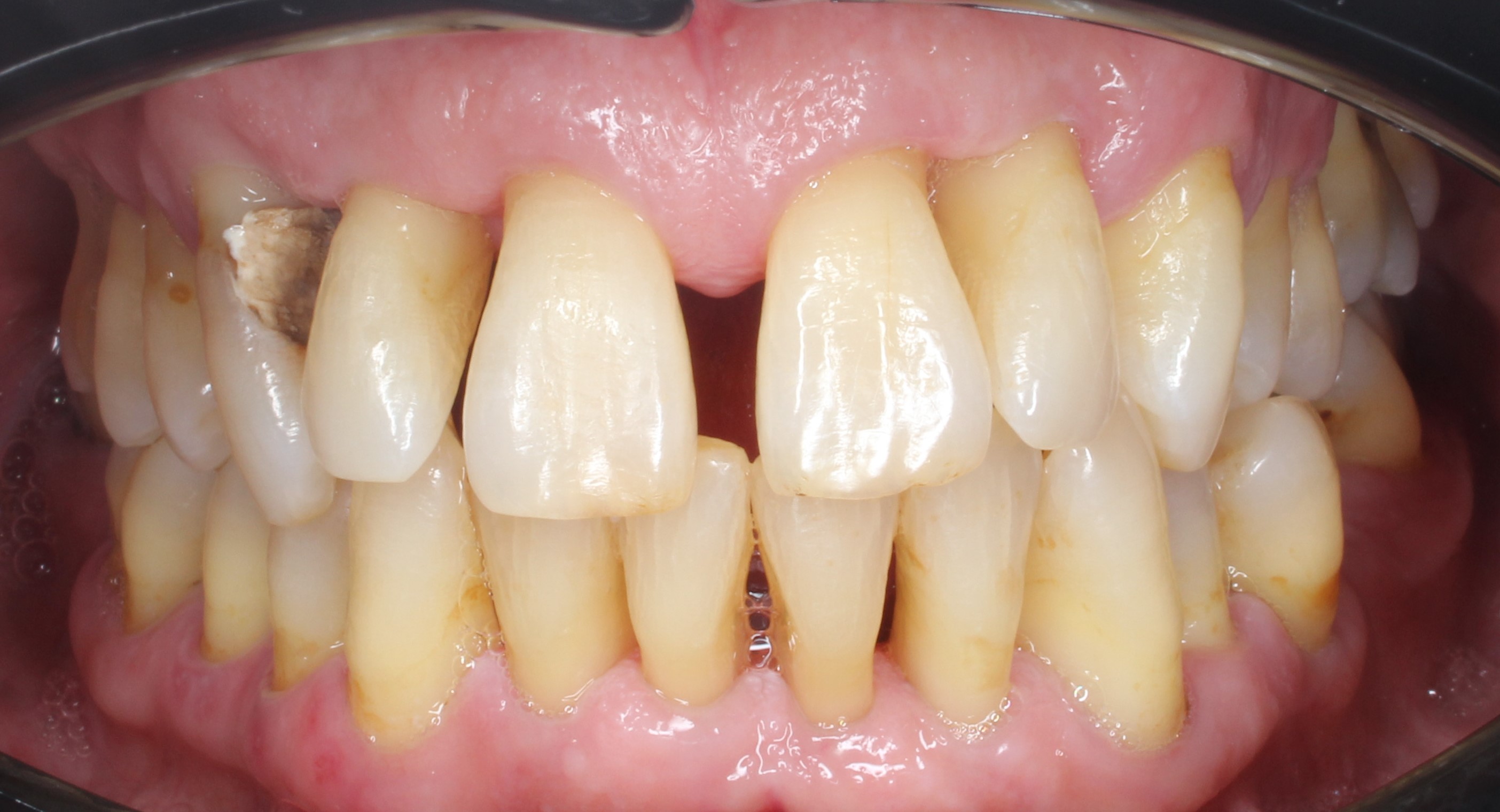 Tratamientos de periodoncia