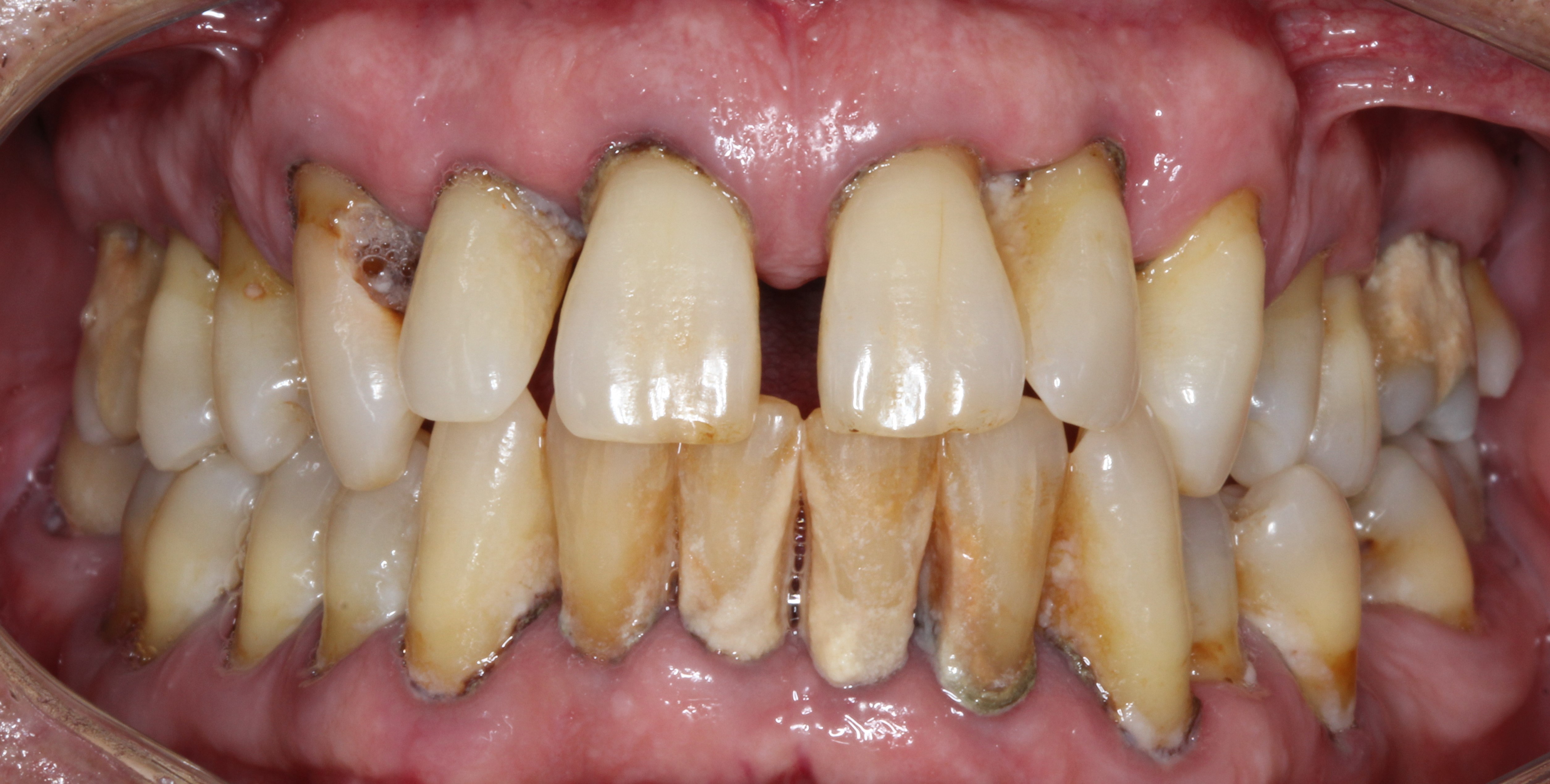 Tratamientos de periodoncia