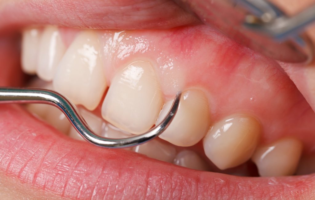Periodontitis- Clínica dental Luis Sánchez