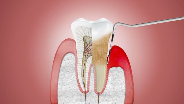 tratamiento-de-periodoncia Tratamiento de periodontitis en la clínica dental Belén Pérez en Getxo