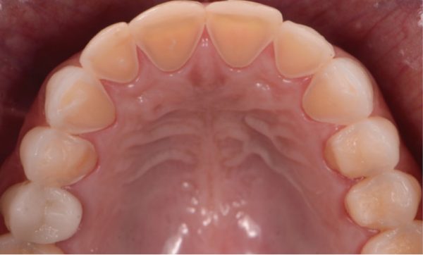 erosion-dental-01 ¿Qué es la erosión dental?