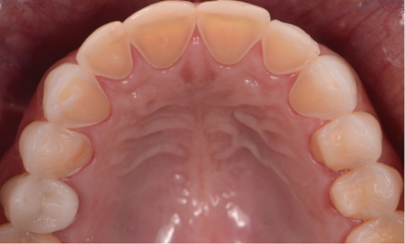 ¿Qué es la erosión dental?