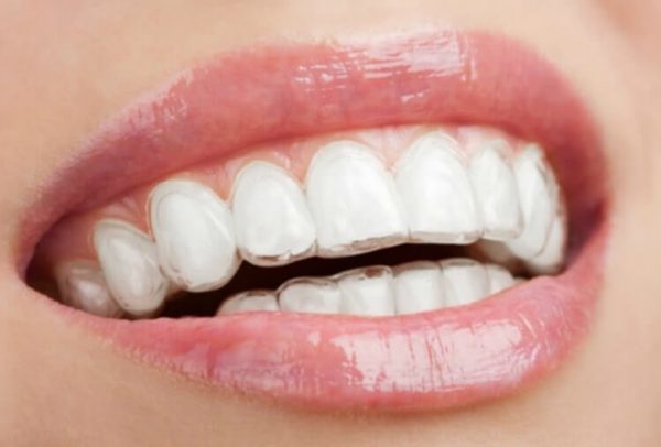 blanqueamiento-dental-en-casa Causas maloclusión dental - Belén Pérez, dentista en Getxo