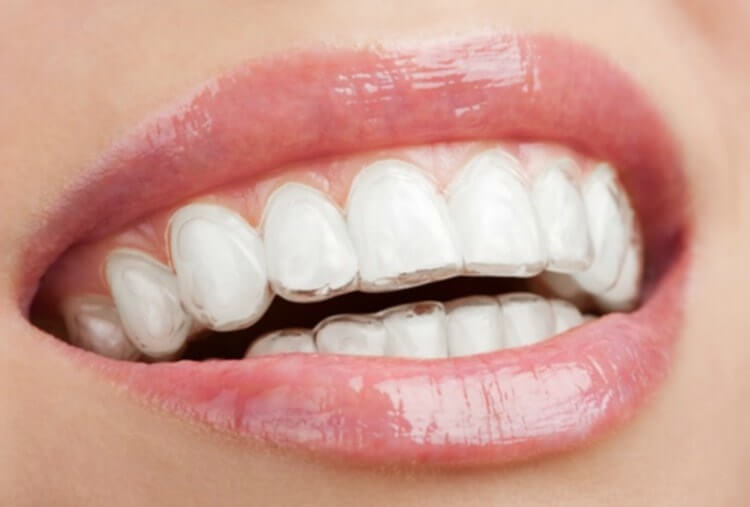 Causas maloclusión dental - Belén Pérez, dentista en Getxo