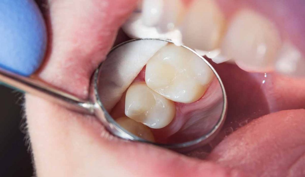 pulpitis reversible - Luis Sánchez, clinica dental Getxo