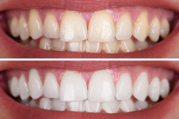 tipos-de-blanqueamiento-dental-1 tipos de blanqueamiento dental en casa