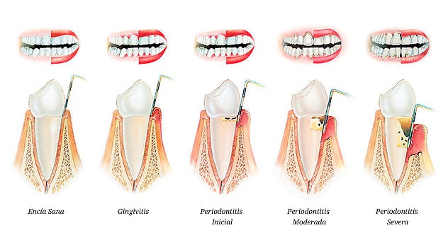 Fases de la enfermedad periodontal - Luis Sánchez dentista