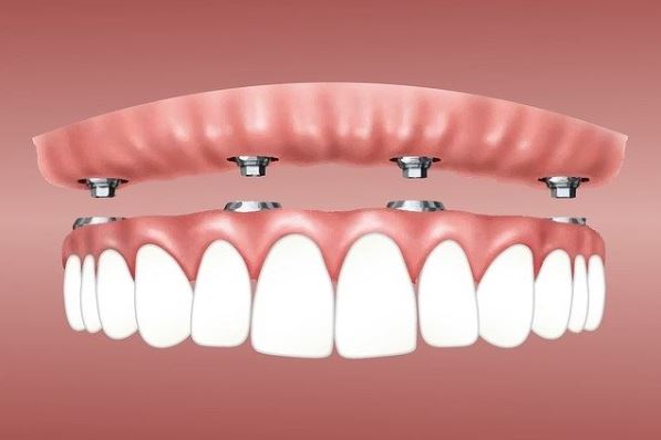 Implante de una dentadura - Luis Sánchez Clínica dental en Getxo