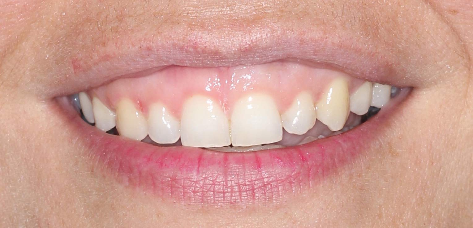 tratamiento de alargamiento de corona dental estética