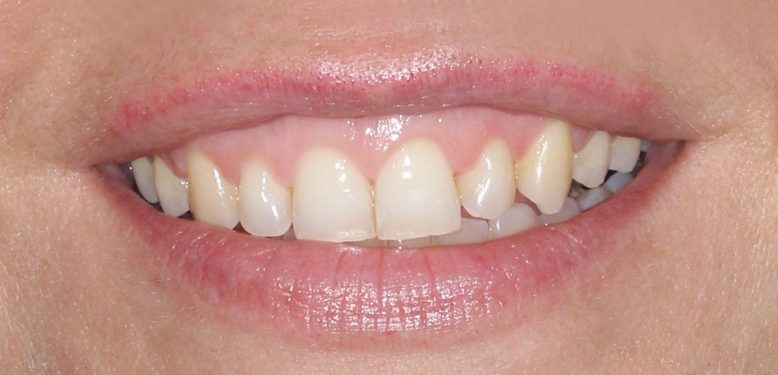 alargamiento de corona dental en getxo