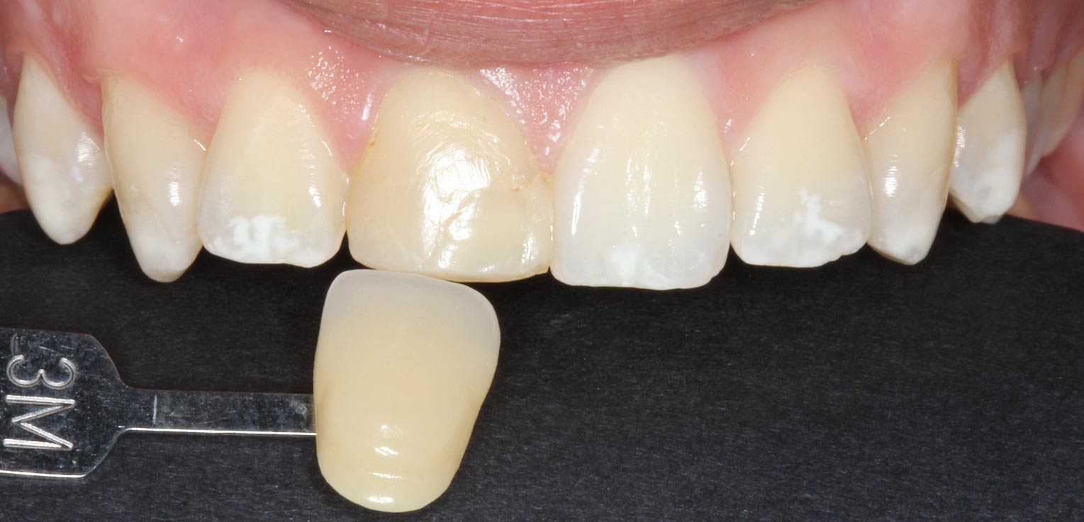 reconstruccion dental con composite