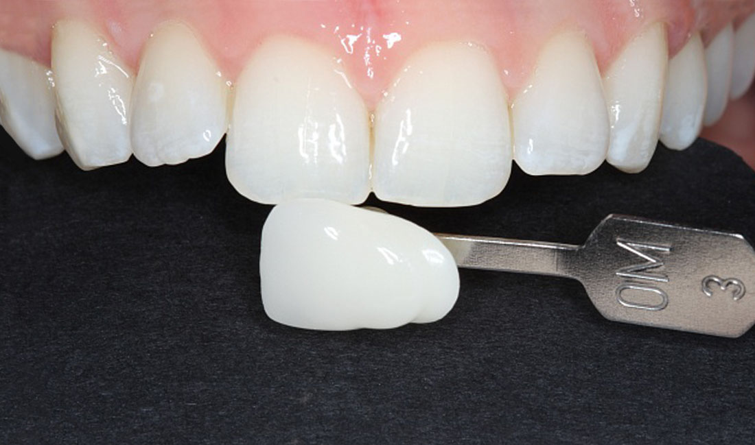 blanqueamiento dental externo domicialiario en getxo