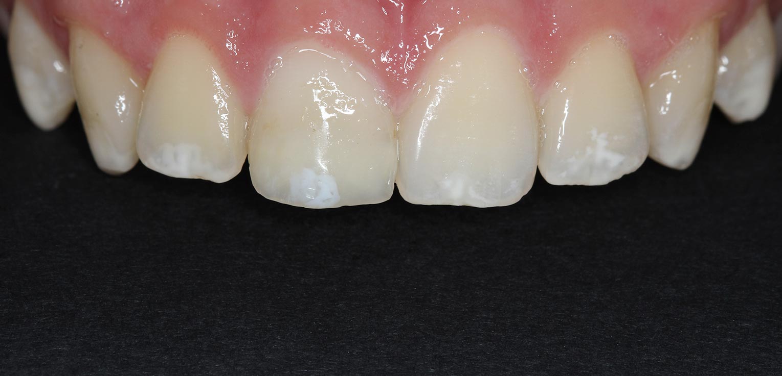 reconstruccion dental con composite en getxo