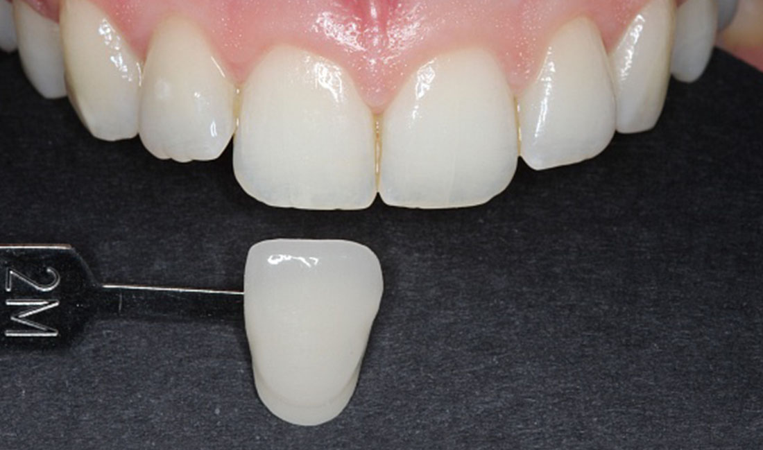 tratamiento de blanqueamiento dental en getxo