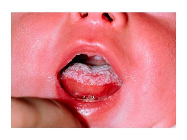 candidiasis-oral bebe candidiasis bucal en bebés