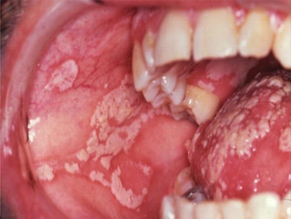 candidiasis bucal 