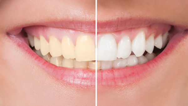 dientes oscurecidos 2 qué son los dientes oscurecidos