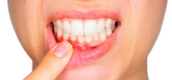 gingivitis-2 Diferencia entre periodontitis y gingivitis - Belén Pérez, clínica dental en Getxo