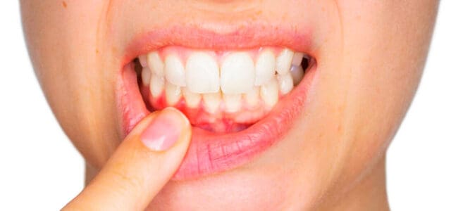 Diferencia entre periodontitis y gingivitis - Luis Sánchez, clínica dental en Getxo
