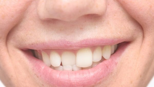 bp 3 ¿Qué es la maloclusión dental?