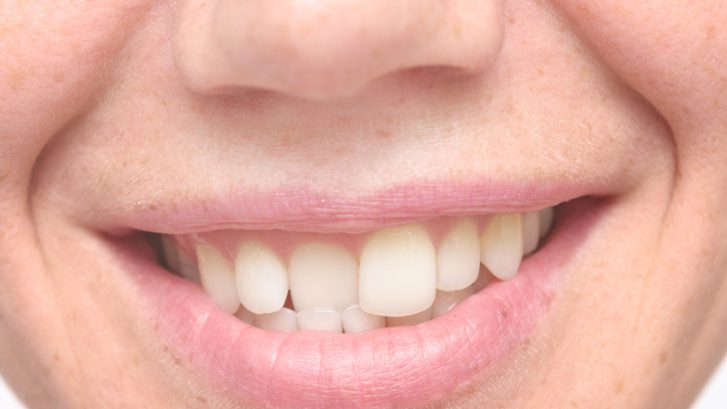 ¿Qué es la maloclusión dental?