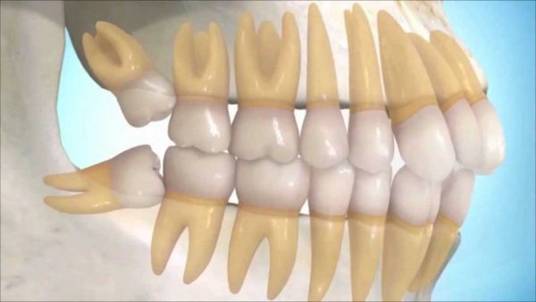 MUELAS-DEL-JUICIO Muelas del juicio retenidas - Clínica dental en Getxo, BP