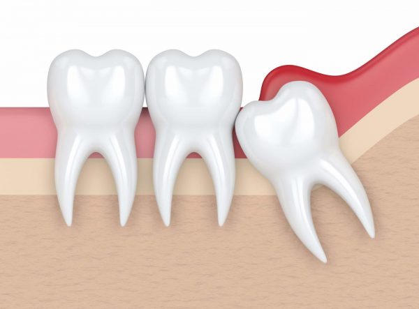 muela-del-juicio Muela del juicio retenida - Belén Pérez, clínica dental Getxo