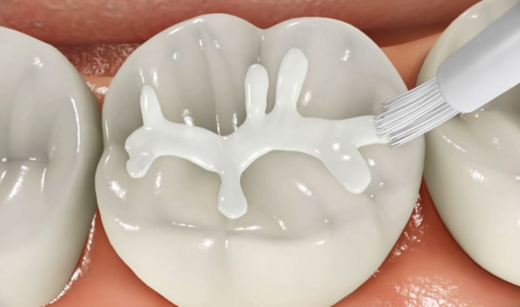 selladores dentales