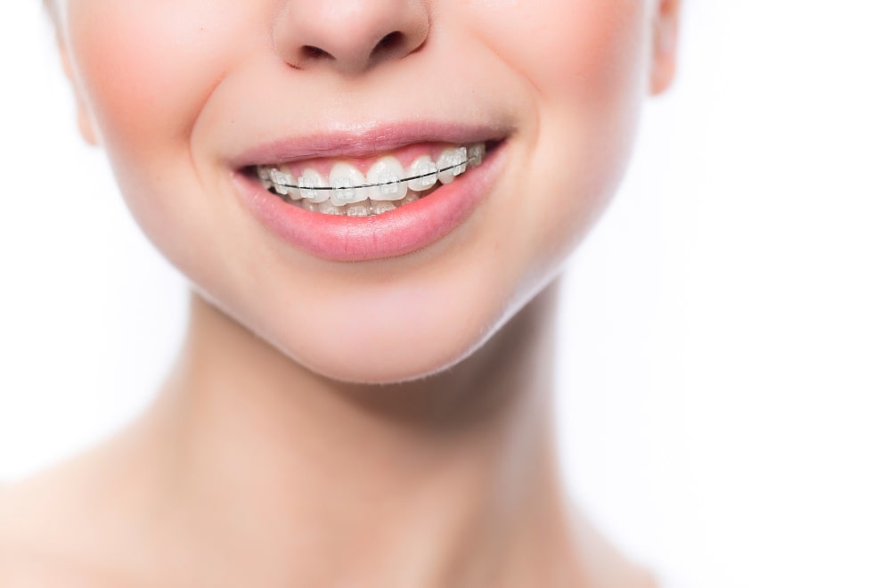 La ortodoncia convencional estética es uno de los tipos de brackets que usamos en Luis Sánchez Dental