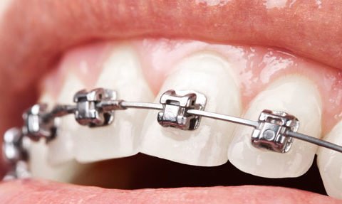 brackets qué alimentos son recomendables - Clínica dental en Getxo Belén Pérez