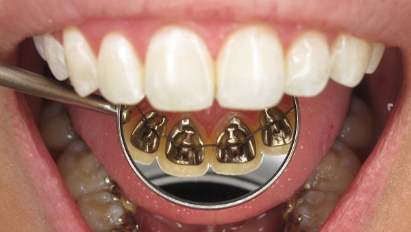 La ortodoncia lingual es uno de los tipos de brackets que usamos en Luis Sánchez Dental