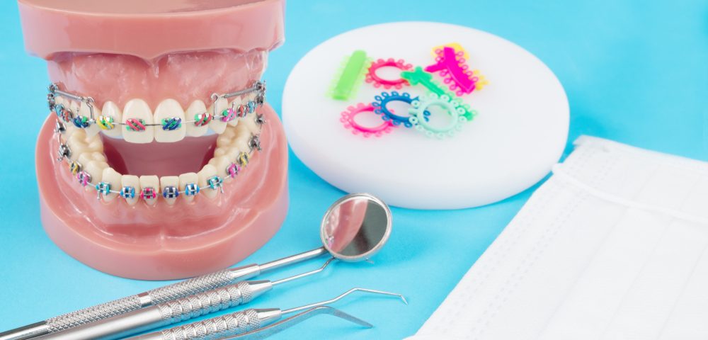 tipos de brackets y de ortodoncia
