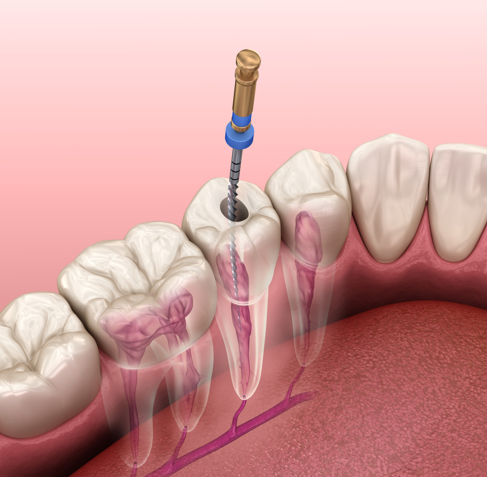 Tratamiento flemon dental - endodoncia Luis Sánchez dental