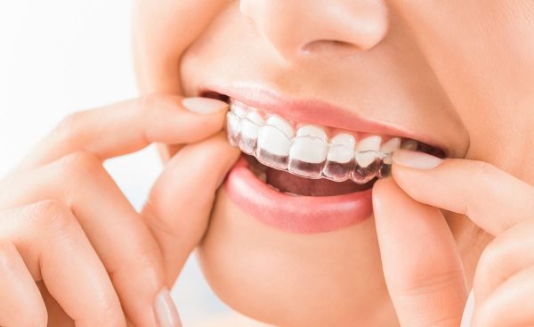 ortodoncia invisalign belen perez gexto invisalign