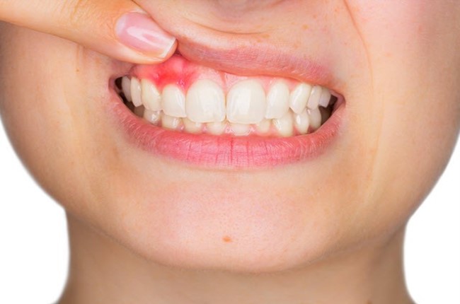 Absceso dental o flemón - Luis Sánchez clínica dental en Getxo