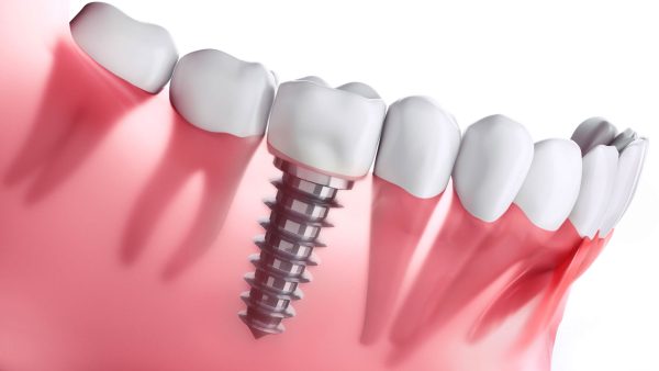 implantes-dentales-en-Saltillo Implantes dentales Getxo - Belén Pérez