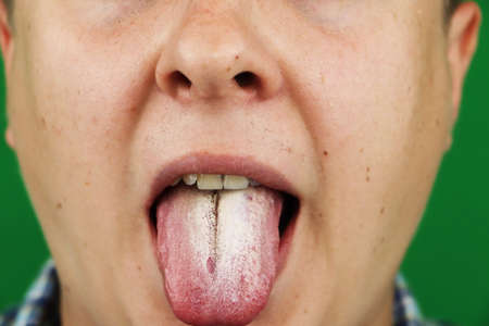 Hongos en la boca- Luis Sánchez, dentista en Getxo