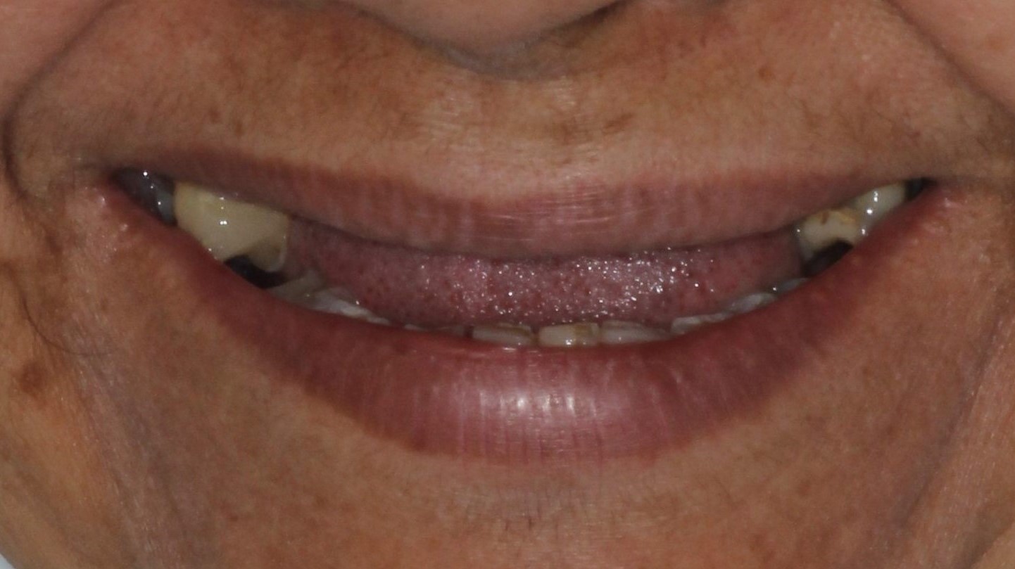 Antes Rehabilitación con implantes osteointegrados