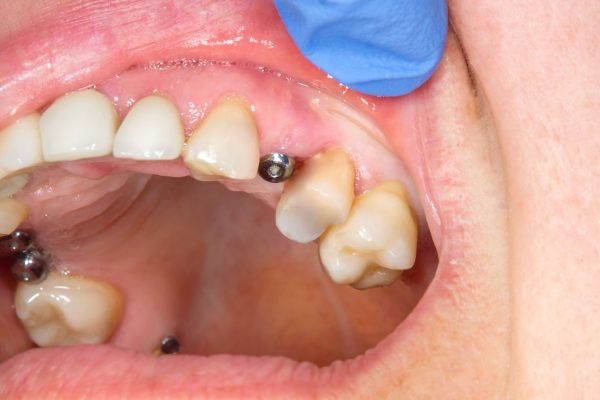 implantes-dentales-cicatrizacion Cicatrización implantes dentales