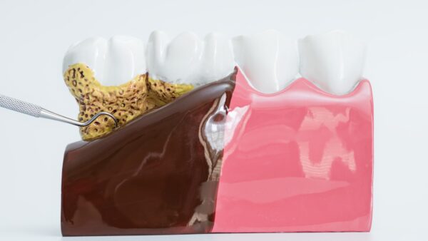 bolsa-periodontal