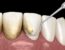 curetaje dental en Getxo
