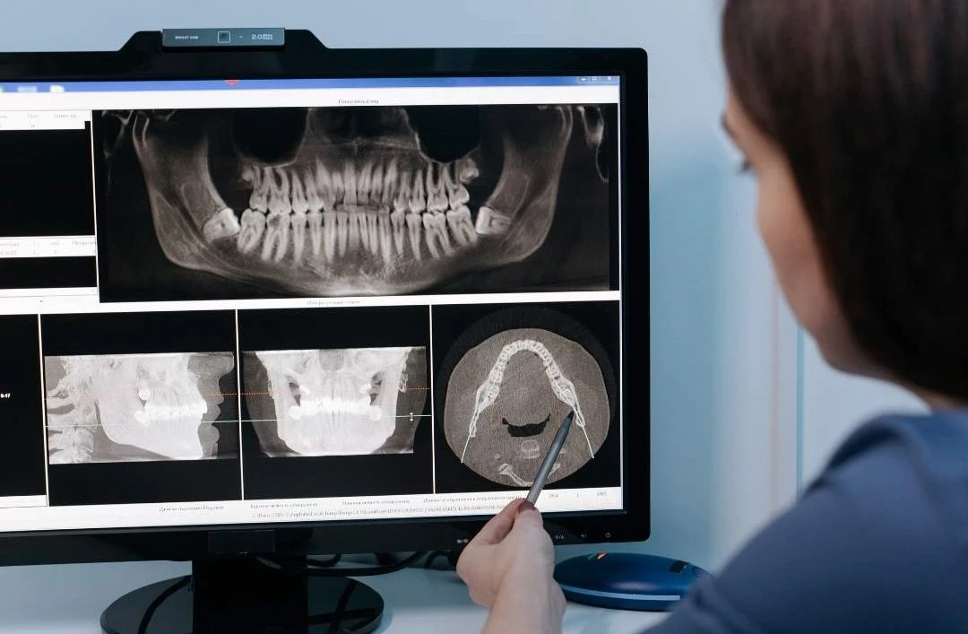Implantes poco hueso