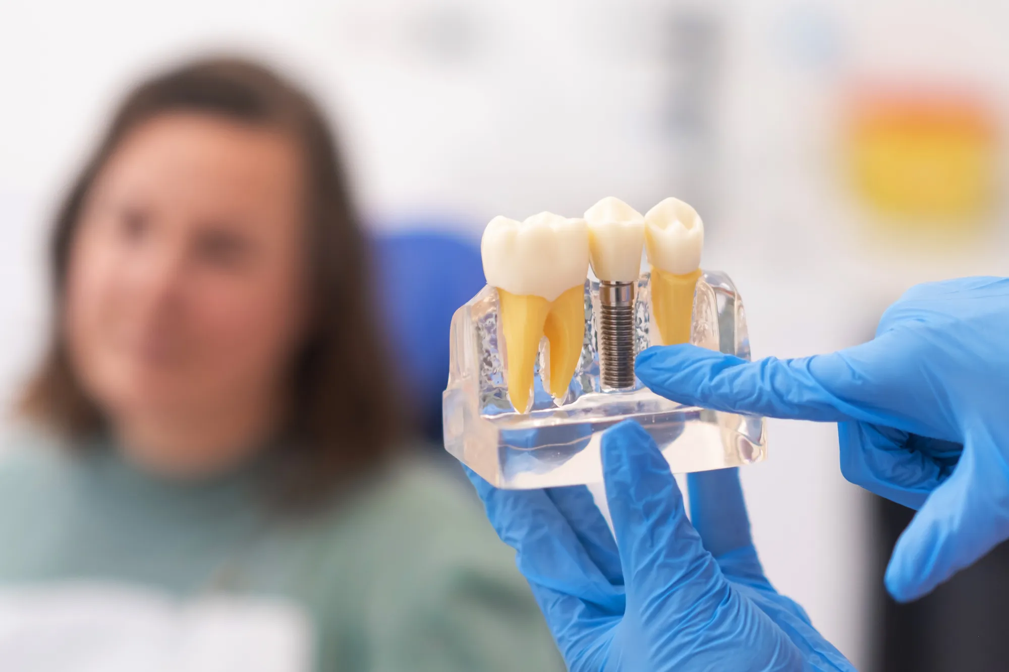Proceso de colocación de implantes dentales